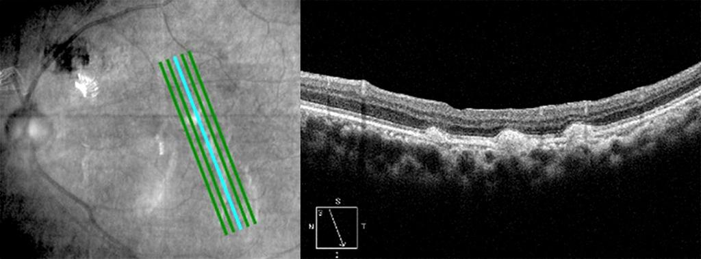 () Foveal vertical section, surface, and outer retinal images spectral-domain optical coherence tomography (SD-OCT) of the left eye.