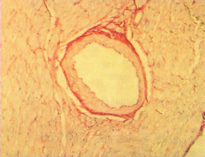 arterial wall thickening