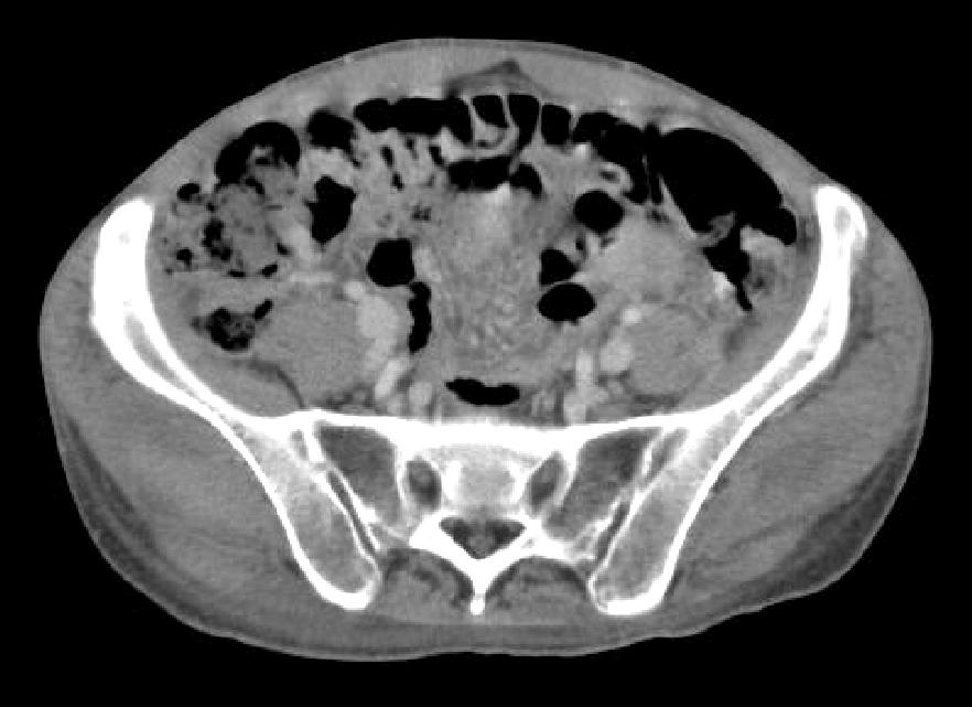 결핵성복막염과동반된 Poncet s Disease 57 Figure 3. Contrast-enhanced abdominal computed tomography.