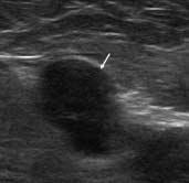 . Color Doppler sonography shows increased hilar vascularity of lymph node. C. Photography reveals multiple small sized epithelioid granulomas (H & E).