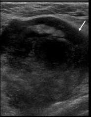 conglomerated, heterogeneously enhanced masses (white arrow) in left axillar. Fig.
