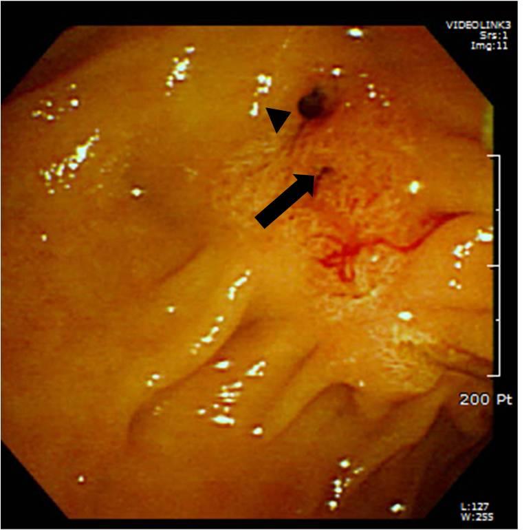 hepatic lobe. () IHD and common bile duct (CD) dilation with heterogeneous, voluminous bile are seen.