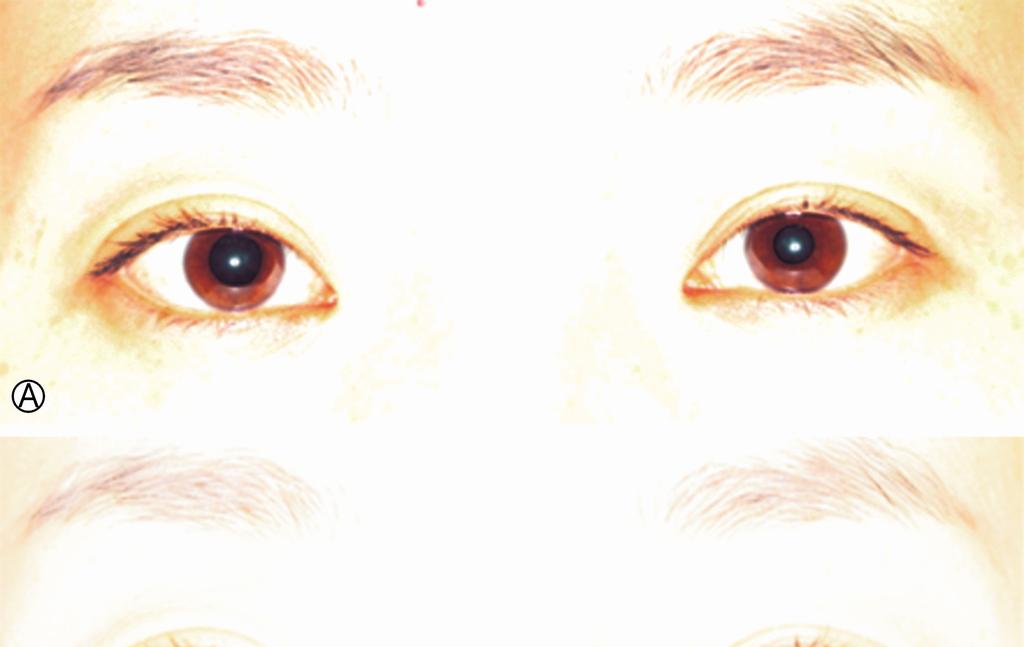 Clinical approach to pupillary abnormalities 안와에서교감신경섬유들은긴섬모체신경 (long ciliary nerve) 을형성하여동공확대근과아래 / 위눈꺼풀판근 (Müller muscle) 을지배한다. 교감신경계의이러한긴주행경로를이해하면환자가보이는다양한증상과증후들을결합하여병터의위치를예측하는데유용할수있다.