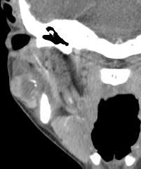 44-year-old female with carcinoma-ex-pleomorphic adenoma in the right parotid gland.