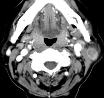 There are multiple inhomogenously enhancing nodular masses in the both parotid glands