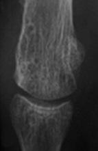 Sung-Hyun Lee, et al. Approach for the Treatment on Hallux Valgus 145 이호전됨을보고하기도하였다 (Fig. 2). 8-10) 2.