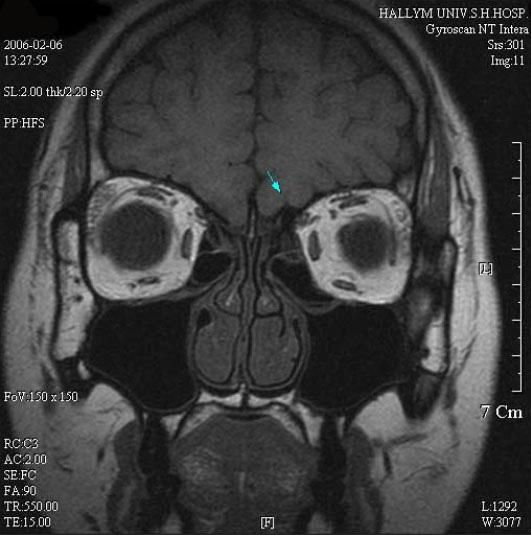 대한내분비학회지 : 제 22 권제 2 호 2007 A B Fig 1. Olfactory MRI - Coronal Section (A-T1, B-T2 image). Both olfactory bulbs are not visualized.