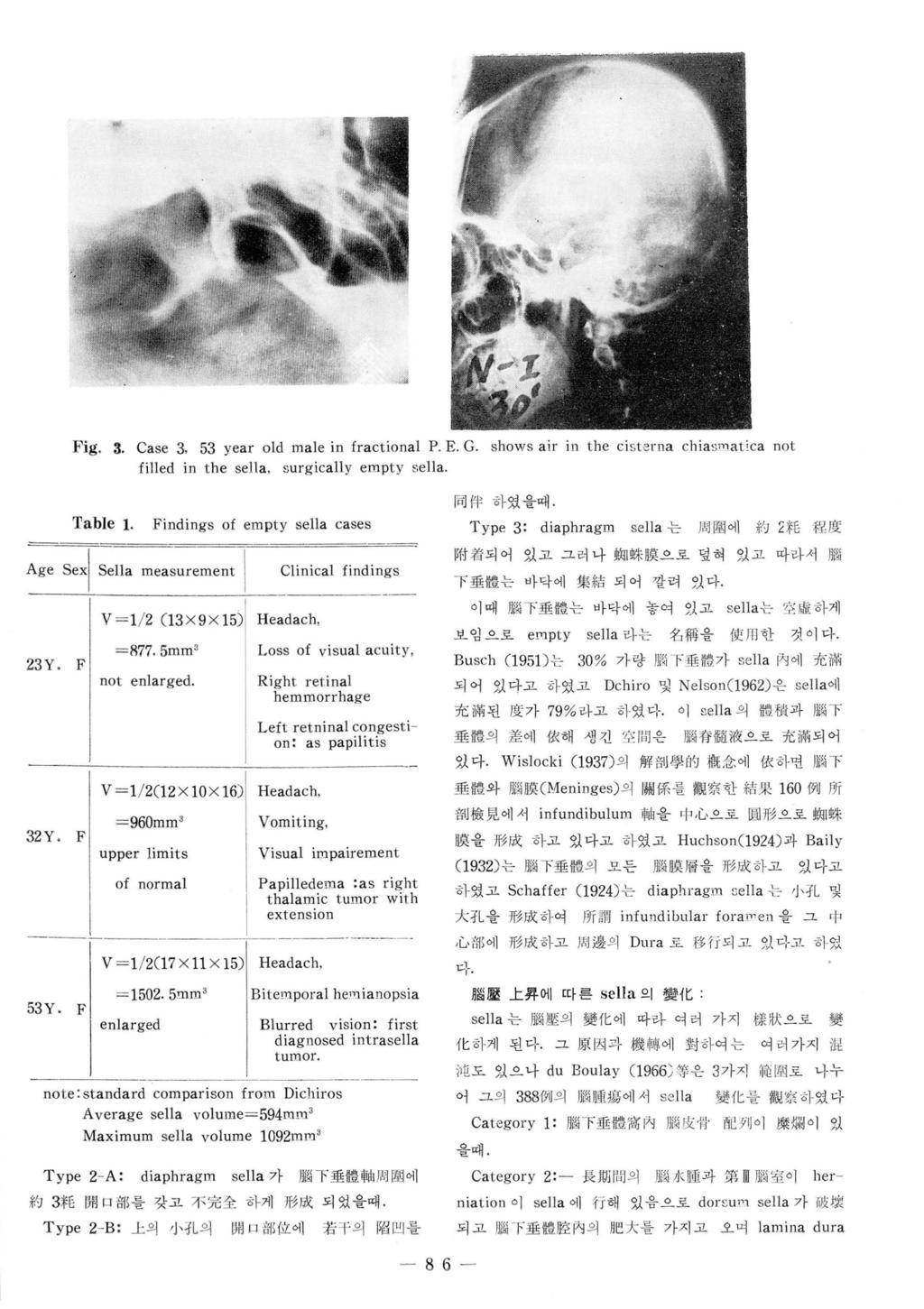 Fig. 3. Case 3, 53 year old male in fractional P. E. G. sho ws air in the cisterna chia""'atica not filled in t he sella, surgical1y empty sel1a. 'fa ble 1. Age sexl Sel1a measurement I 23Y. F 32Y.