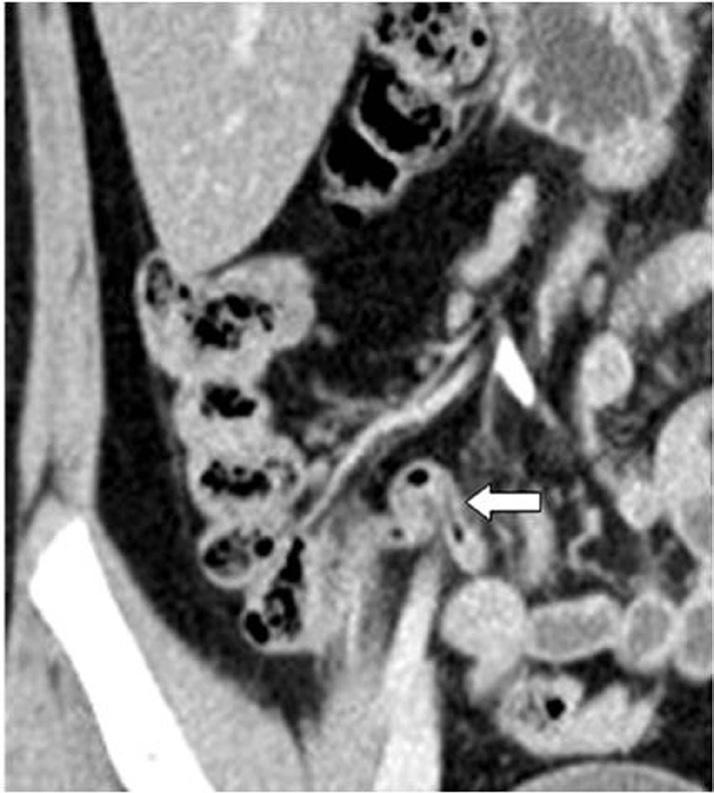 Coronal reformation image shows an appendix (arrow) with intraluminal gas in the medial aspect of the cecum, located between the terminal ileum and the psoas muscle (type
