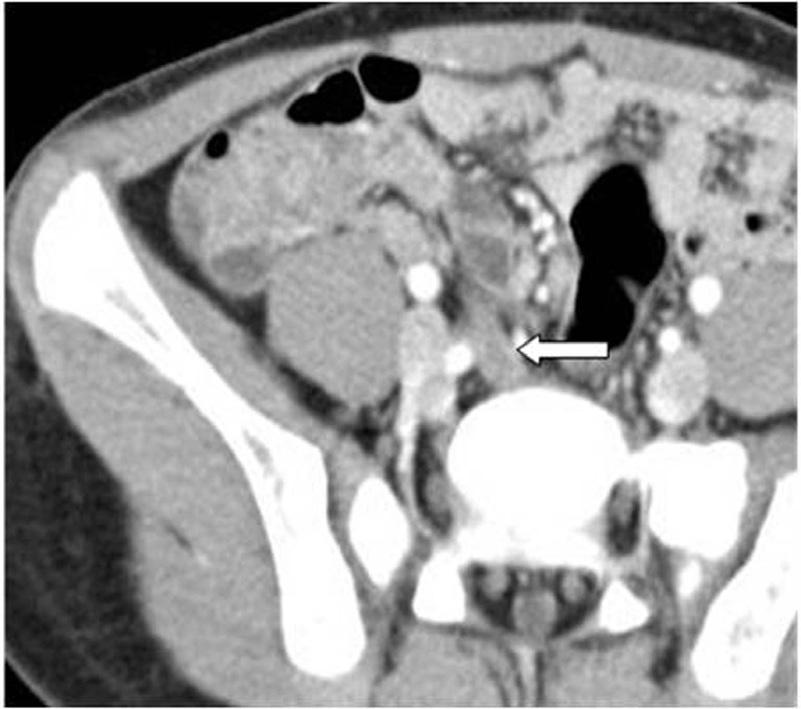 소아에서정상충수의 Multi-Detector CT 소견 A B C Fig. 3. CT images show unusual locations of appendiceal tip on contrast-enhanced multi-detector CT scans. A, B.
