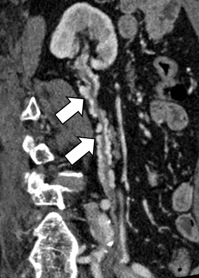Mild thickening with enhancement of the left renal pelvic wall