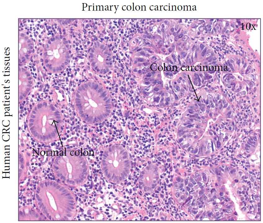 Model of Colorectal