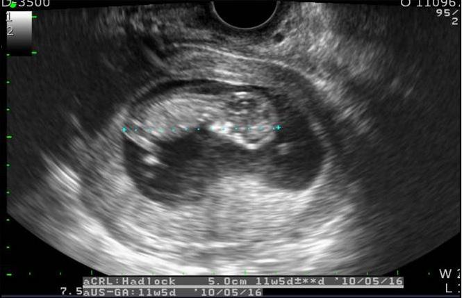 Young-Ran Kim, et al. Prenatal diagnosis of double aneuploidy 서자궁내정자주입술 (intrauterine insemination) 을 3번, 정자직접주입술 (intracytoplasmic sperm injection) 을 1번시행하였으나실패하였다.
