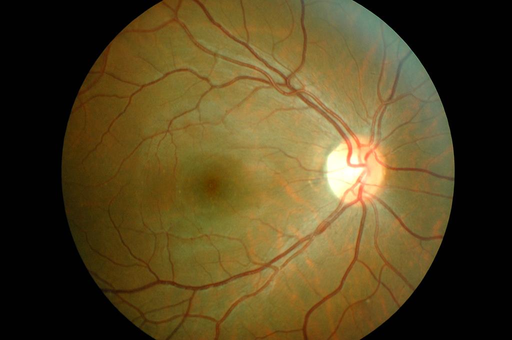 - 대한안과학회지 2015 년제 56 권제 9 호 - A B Figure 1. Fundus photographs at the first visit. These show no specific lesion on the right eye (A) and left eye (B). 인색각이상및시야감소를경험하여이를보고하고자한다.