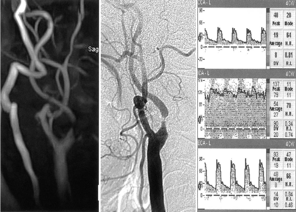 1. High grade stenosis of M1 portion of right middle cerebral artery is seen on 3T- TOF-MR angiogram, transcranial Doppler sonograph, and conventional angiogram in a 47-year-old-woman.