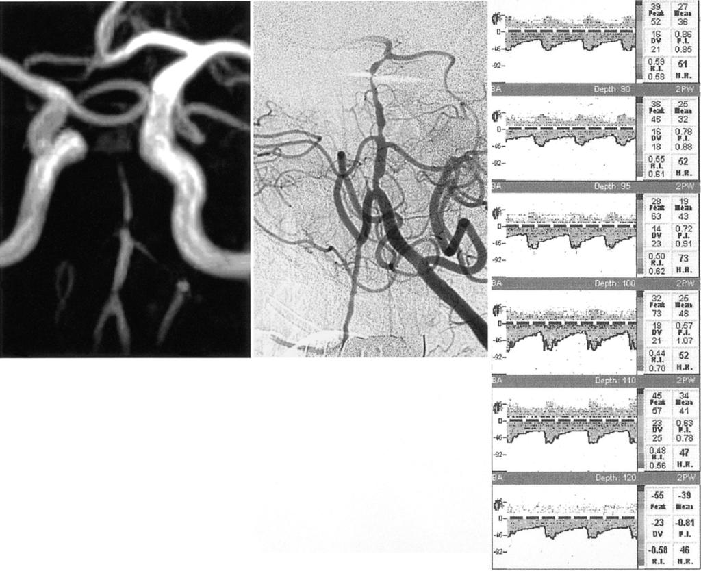 한제희 외 b a Fig. 3. Multifocal stenosis of basilar artery is noted on 3T-TOF-MR angiogram, transcra- nial Doppler sonograph, and conventional angiogram in a 65-year-old-man.