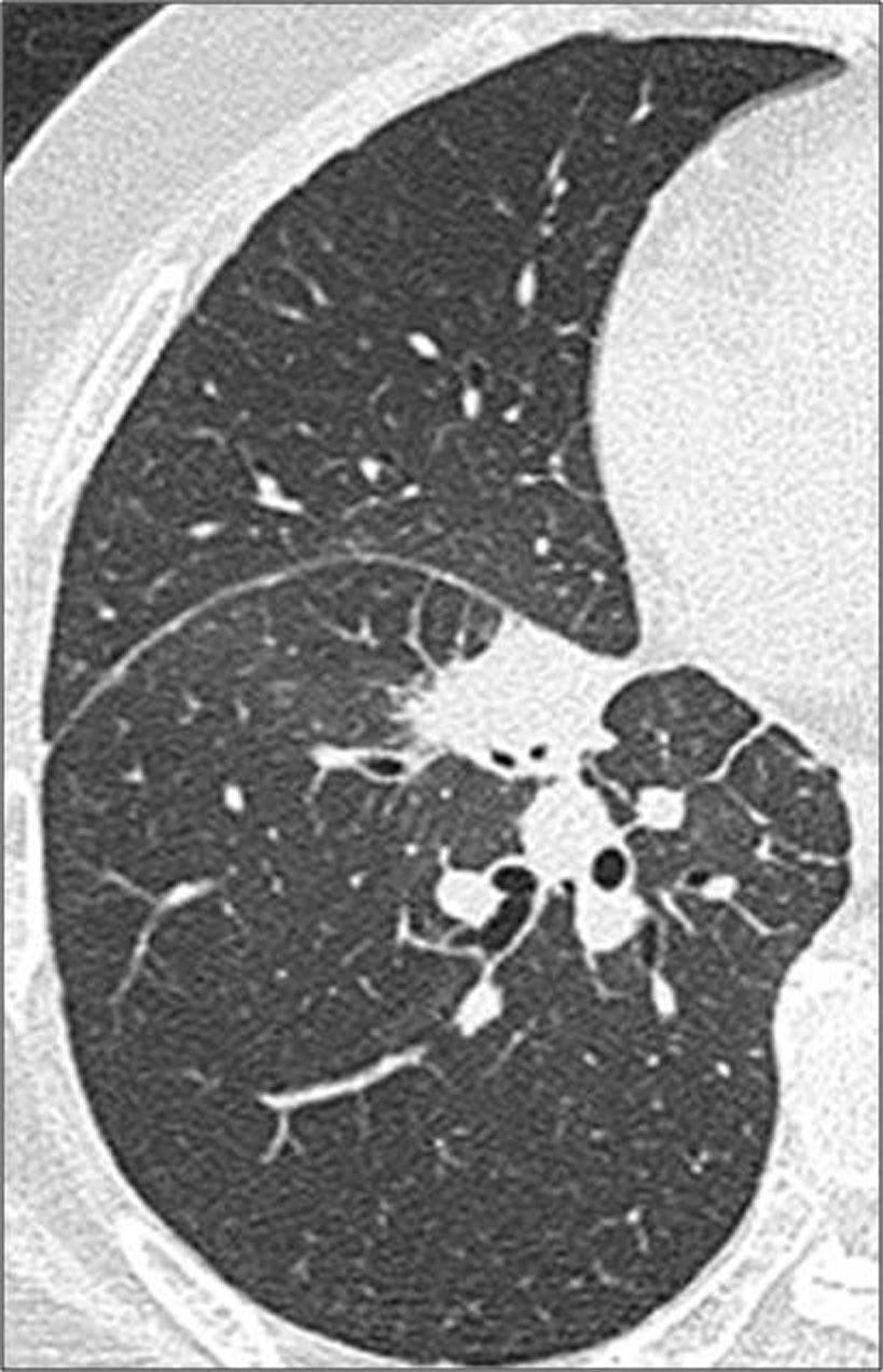 CT Finding of Radiation Induced Pulmonary Injury CT Finding No of Lesion (%) Radiation pneumonitis 37 of 39 lesions (95) GGO 7 (19) GGO and consolidation 20 (54) Patchy consolidation 6 (16) Diffuse