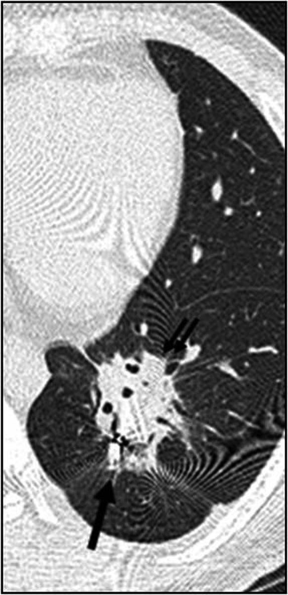 1일조사분할 (daily dose fraction) 과분할횟수도방사선폐렴과직접적인 A B C D Fig. 3. A 29-year-old man with sarcoma metastasis, 52 Gy/ 3 fractions. A. Pre-treatment CT scan shows a well-circumscribed tumor in the left lower lobe.