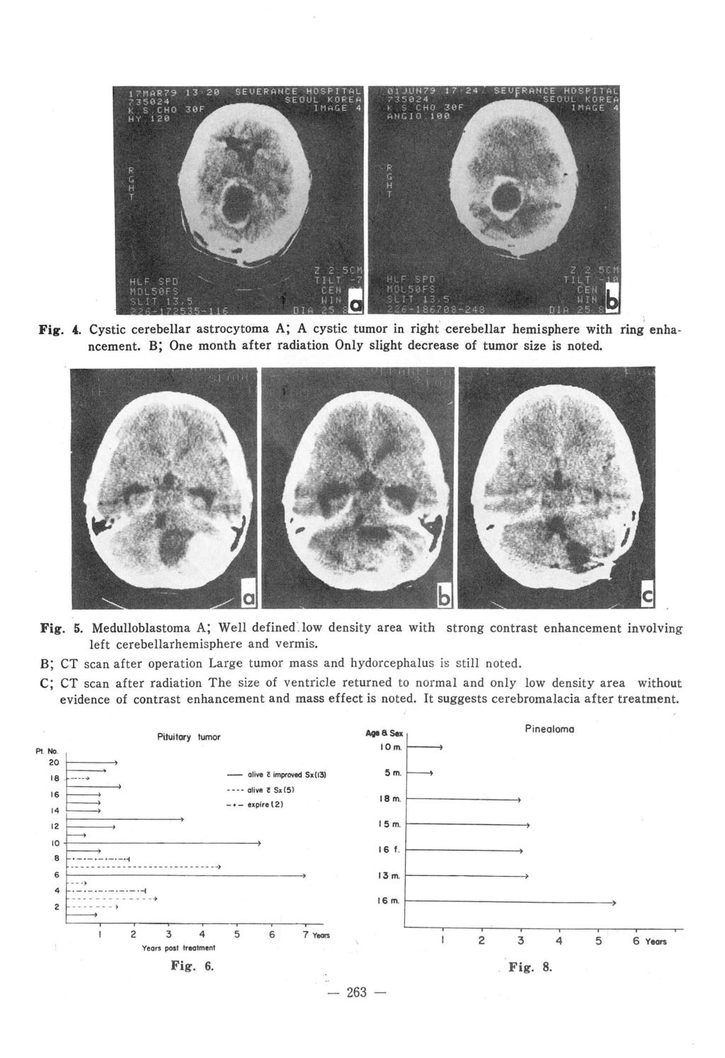 Fig. 4. Cystic cerebellar astrocytoma A; A cystic tumor in right.cerebellar hemisphere with ring enhancement. B; One month after radiation Only slight decrease of tumor size is noted. Fig. 5.