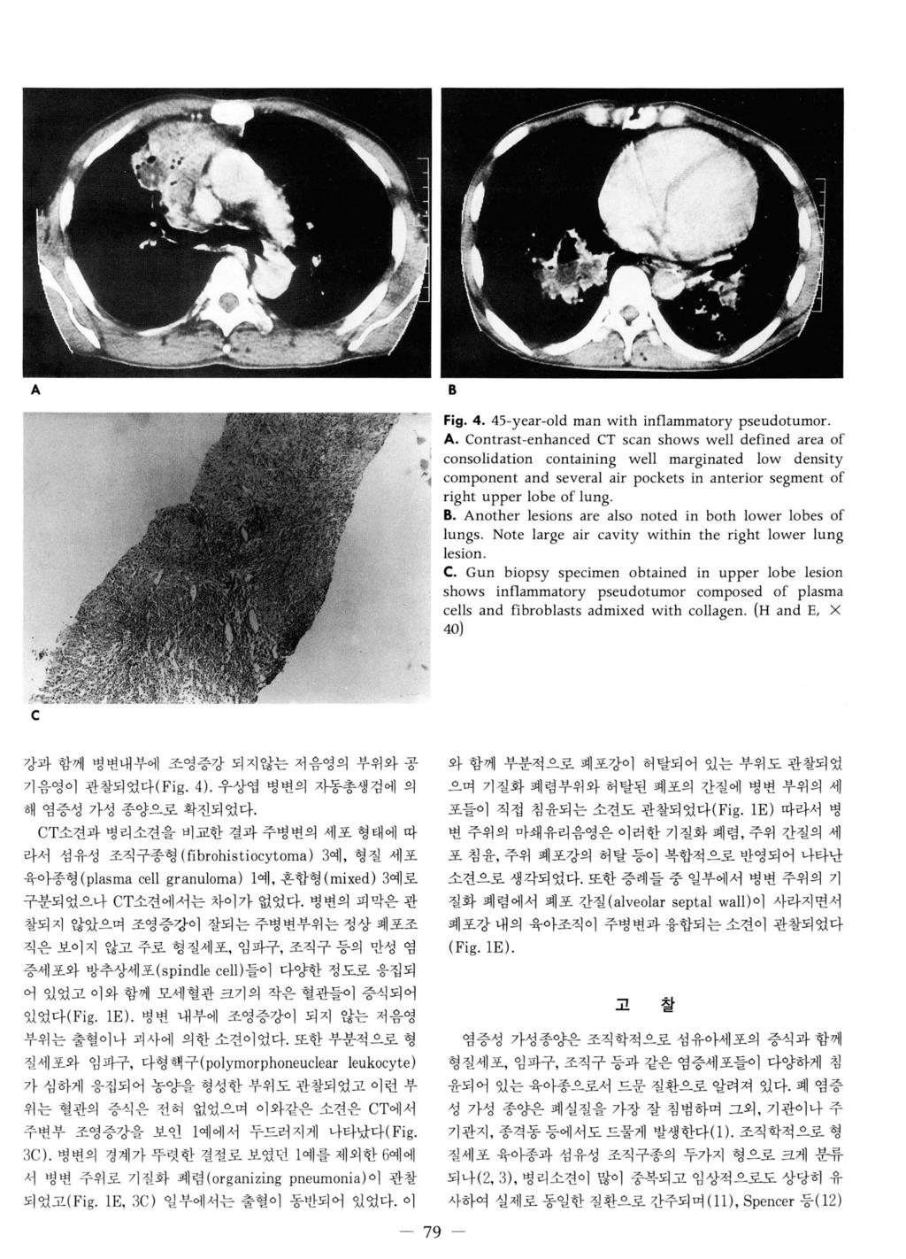 사하여실제로동일한질환으로간주되며 (11), Spencer 등 (1 2) 껴A B Fig. 4. 45-year-old man with in f1ammatory pseudotumor. A.