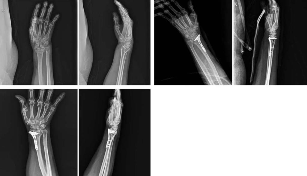 Jong Min Kim, et al. Treatment of Unstable Distal Radius Fracture in the Elderly Patients Fig. 2. Radiographs of 76-yerar-old female who underwent operative treatment.