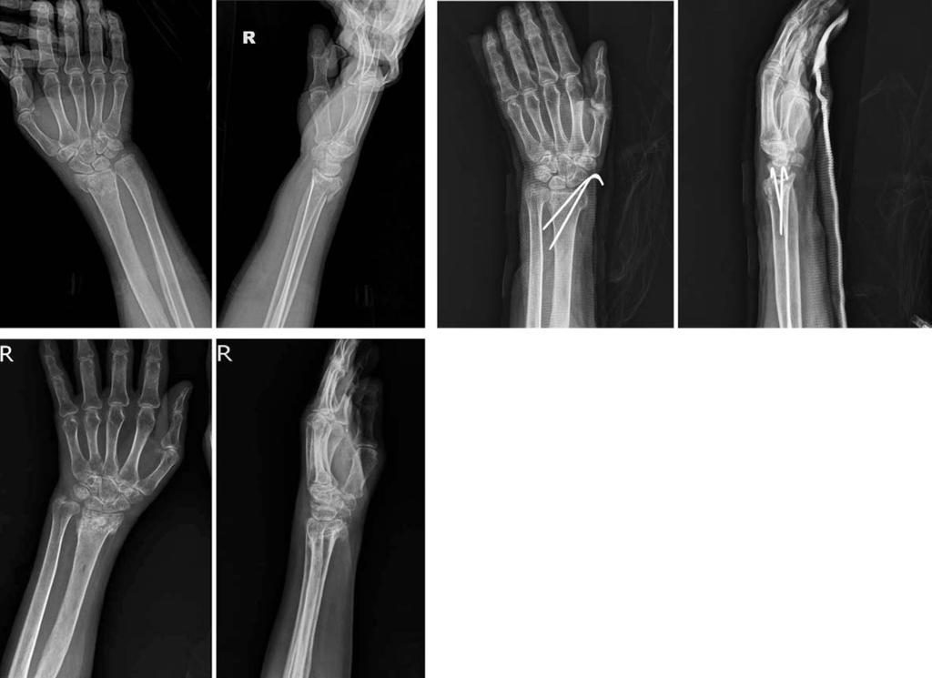 Radial shortening reduced to 0mm and dorsal tilting decreased to 2.2. (C) Seven month follow-up radiographs shows 0.5 mm radial shortening and 4.8 dorsal tilting. Fig. 3.