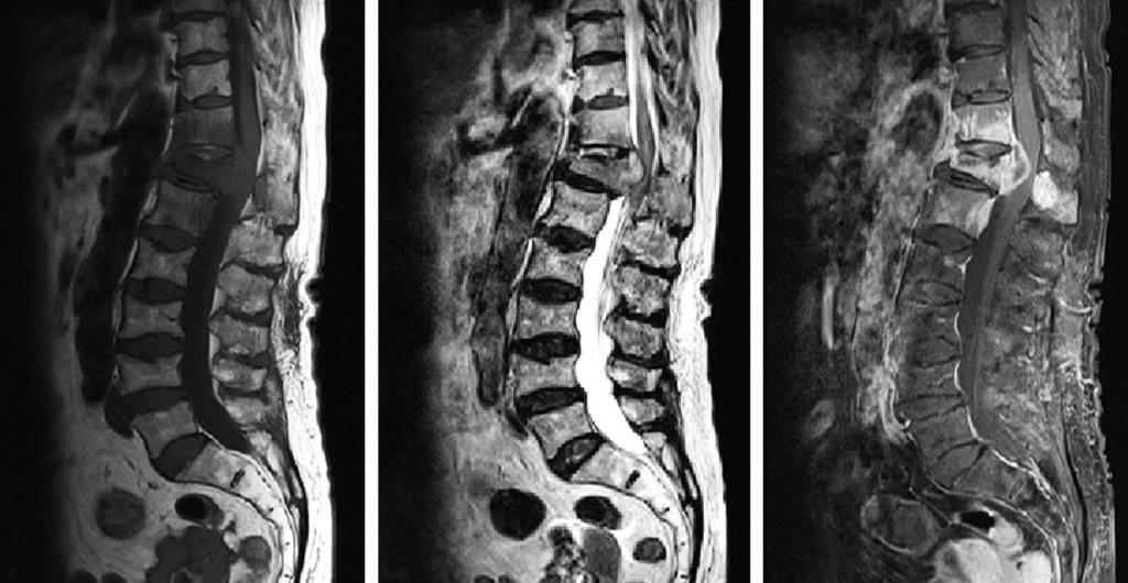 Anteroposterior and lateral X-rays of the T-L spine show a T12 compression fracture. Fig. 3.
