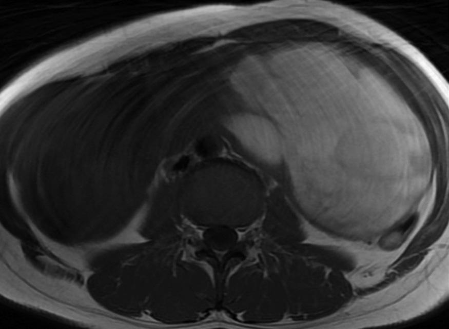 On coronal reformatted contrast enhanced CT image, there are two large lobulated cystic masses with enhancing solid areas and focal