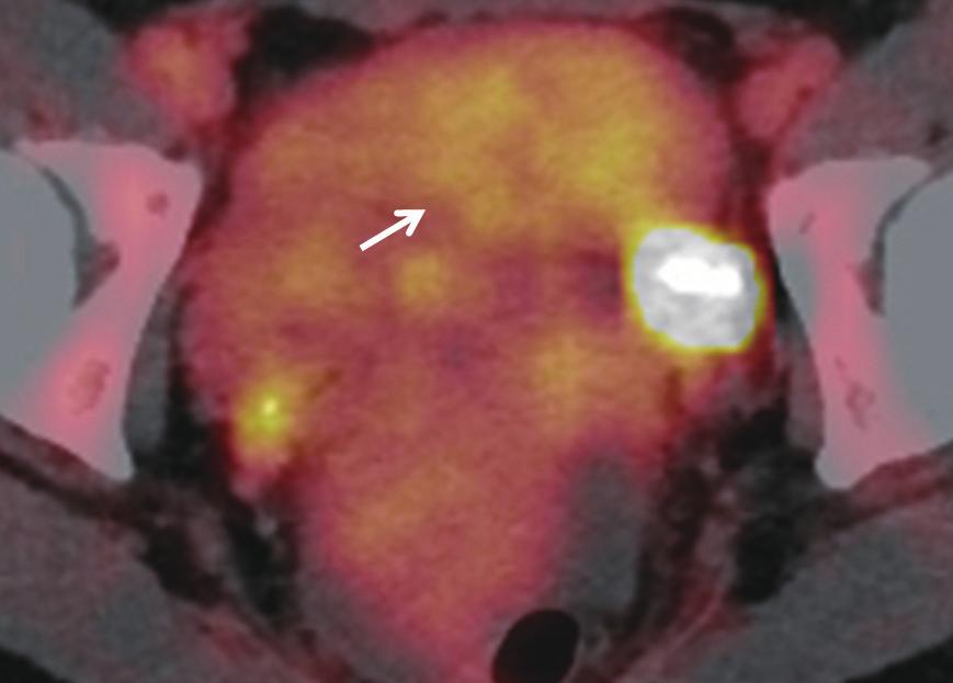 병리조 (Krukenberg s tumor)의 가능성도 감별해야 할 것으로 생각하 직학적 검사에서 낭변성 및 점액변성과 혈액성분이 동반된 유 였다. 경성 장막하 자궁근종으로 확인되었고(Fig. 1J