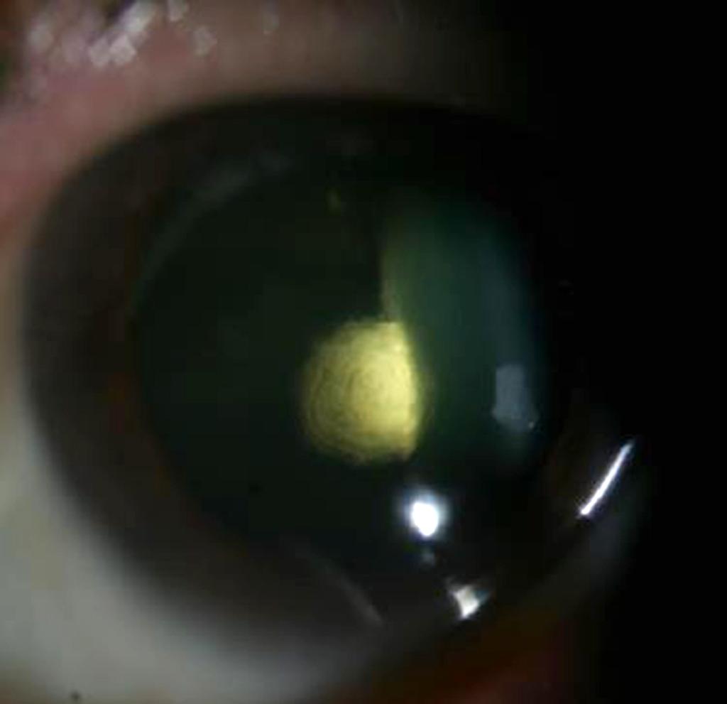 - 한지윤외 : 백내장종류별안내수차패턴분석 - (internal spherical aberration) 변화에의해나타나며, 안구코마값의증가는주로각막코마 (corneal coma) 값의변화에의해나타난다고하였다.
