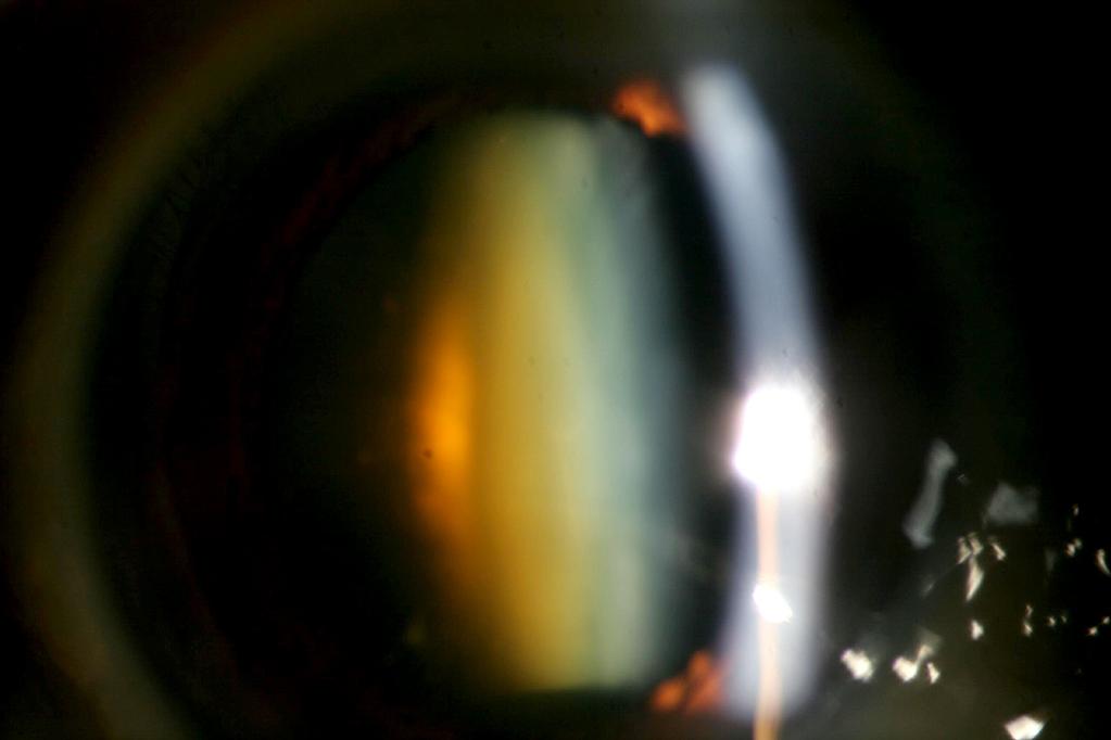 - 대한안과학회지 2015 년제 56 권제 4 호 - A B Figure 6. A case of nuclear cataract that had highly positive spherical aberration.