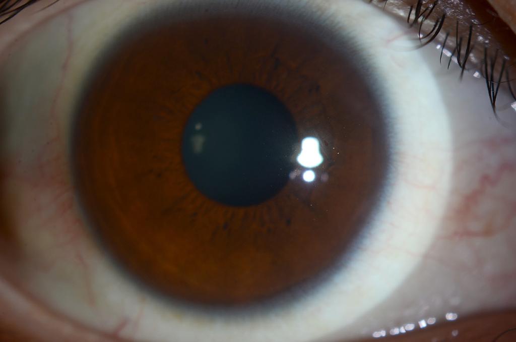 - 대한안과학회지 2015년 제 56 권 제 12 호 - C D Figure 1. nterior segment photographs of both eyes.