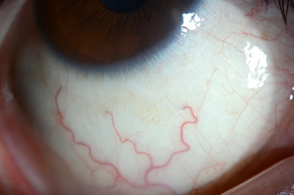 (C, D) Left eye shows prominent episcleral vessel engorgement. Figure 2.