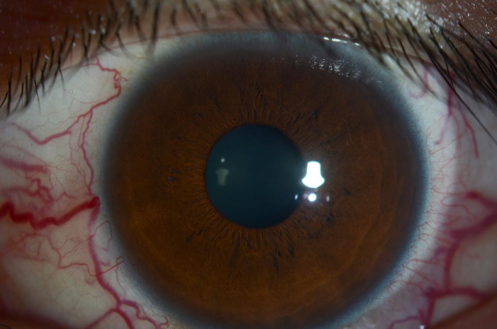 () The right eye shows superotemporal and inferotemporal retinal nerve fiber layer defects.