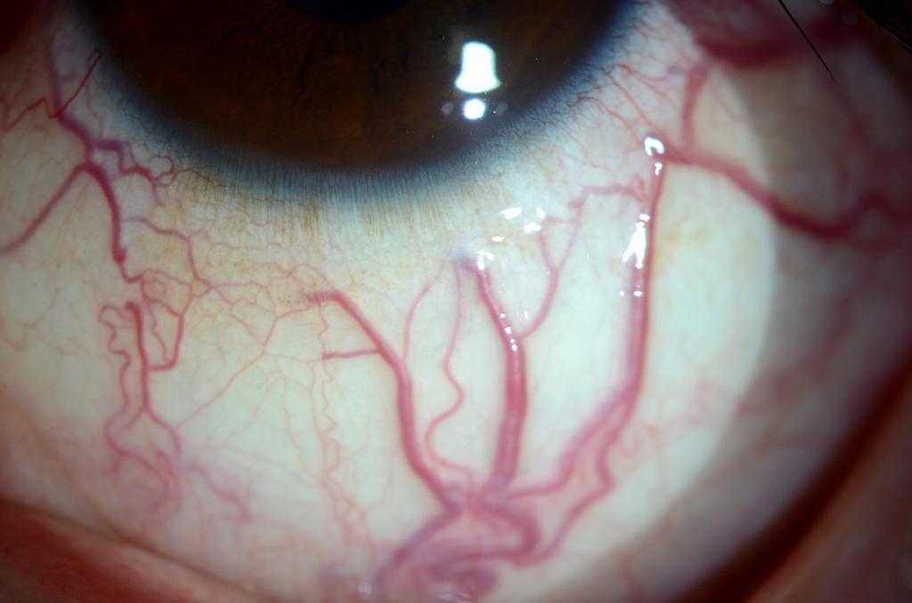 tortuous retinal vessels, optociliary shunt vessels and disc hemorrhage. 증례보고 cm이고 몸무게는 67.