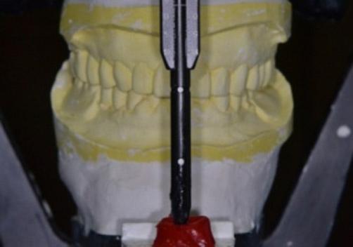 mandibular removable partial denture, () working cast of mandible, ()