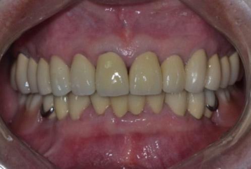 TMJ series after treatment. () Rt. close, () Rt.
