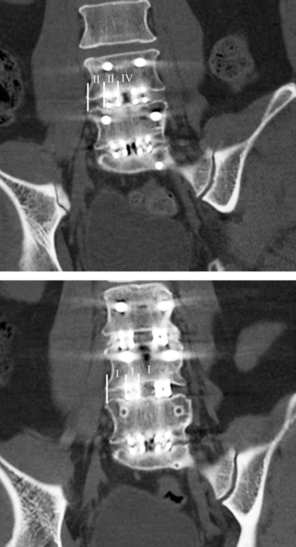 Journal of Korean Society of Spine Surgery Union Pattern of Grafted Bone During Posterior Lumbar Interbody Fusion 이부진한예는이때문인것으로생각된다. CT 상 B 구역에서국소골을충분히다져넣은례로국한하여분석한다면유합률은지금보다높을것으로추정된다.