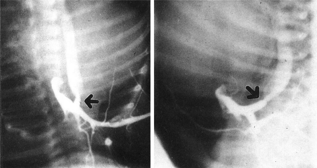 AP and lateral views of counter-current aortography through left radial artery showing normal aortic arch and descending