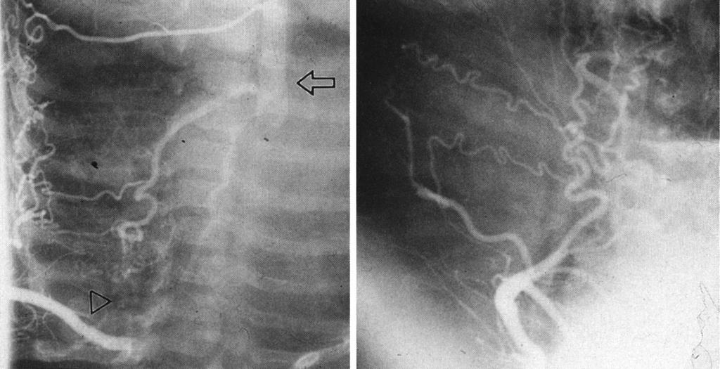 Fig. 4. AP and lateral views of right brachial artery angiogram in a 25-day-old bady with severe COA and left aortic arch. Note that COA is not seen.