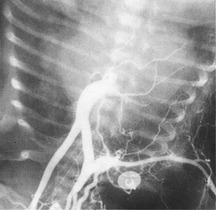 AP view of aortogram in a 15-day-old baby with right aortic arch and IAA type B(interruption between right subclavian and right common carotid artery).