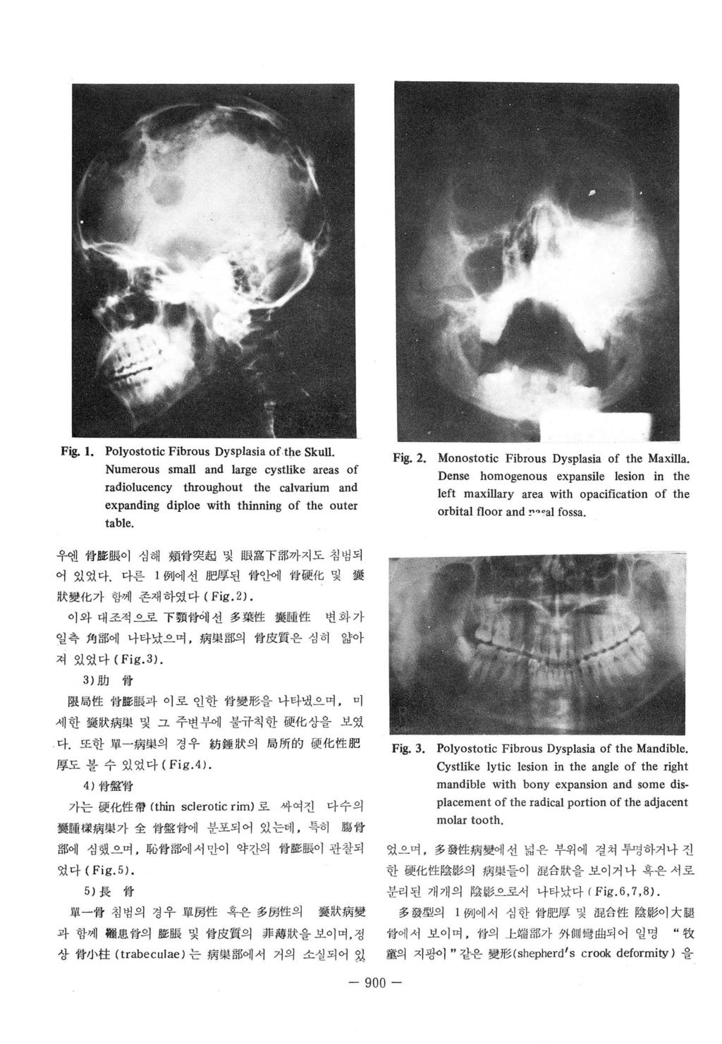 Fig. 1. Polyostotic Fibrous Dysplasia of.the Skull. Numerous small and large cystlike areas of radiolucency throughout the calvarium 때 d expanding diploe with thinning of the outer table. Fig. 2.