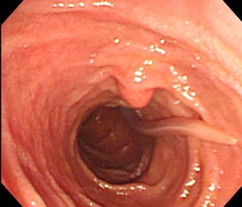 - Jae-Hyung Sun, et al. Biliary ascaris removed by forcep during endoscopy - A B Figure 3. (A) At endoscopy, a live Ascaris lumbricoides is seen in the orifice of the ampulla of Vater.