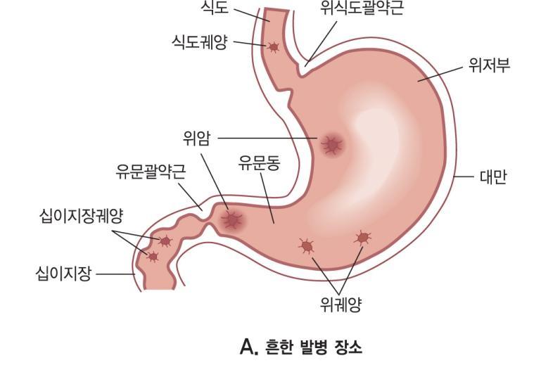 소화성궤양 Peptic ulcer 궤양 :