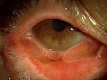 A B Figure 1. (A) Slit lamp photography showing a case of epidemic keratoconjunctivitis.