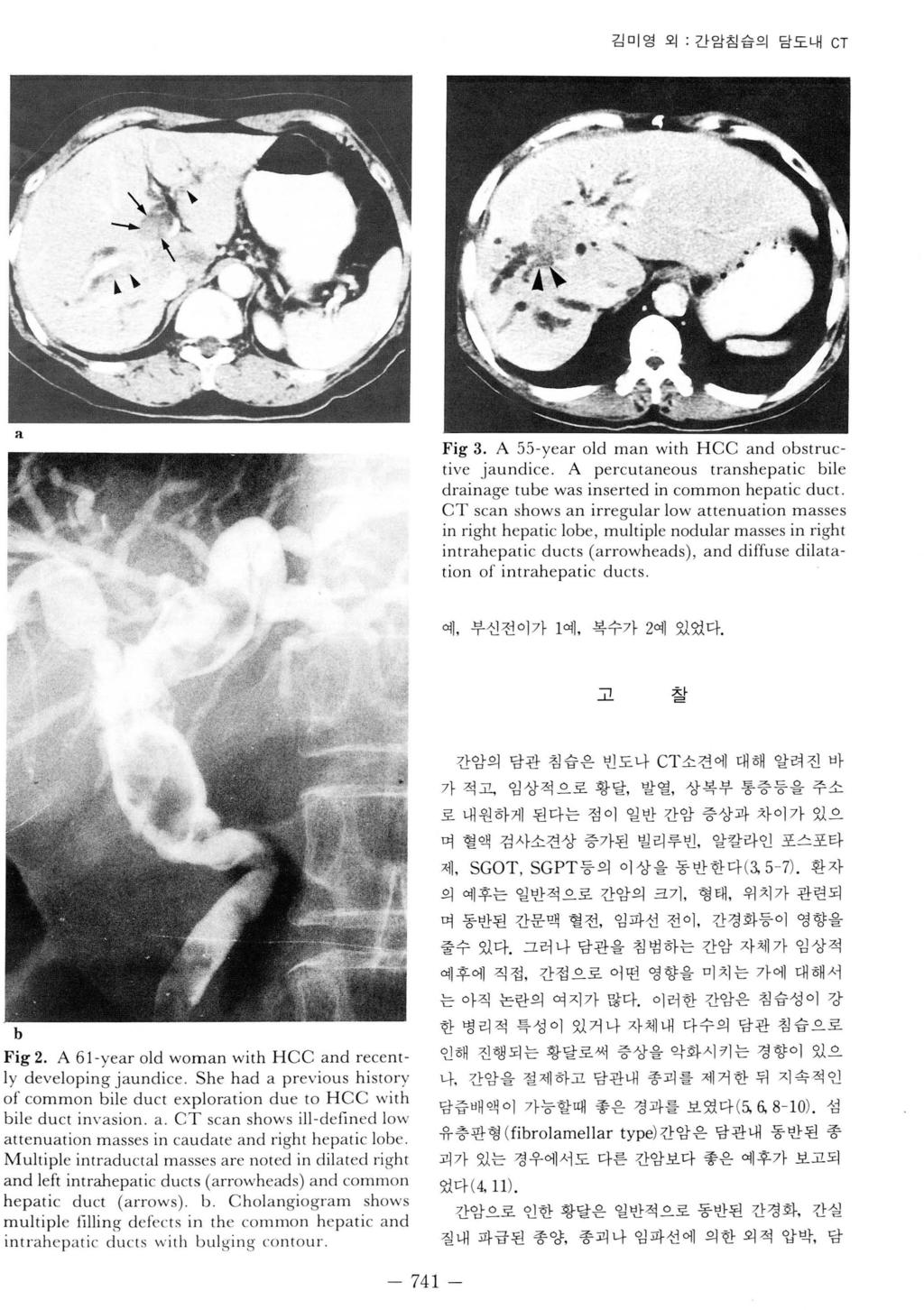김미영외. 간암침습의담도내 CT a Fig 3. A 55-year old m a n with HCC and obstructive jaundice.