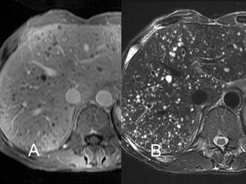 (A) T1-weighted MR image of case 1 showing multiple low-signal hepatic nodules. (B) T2-weighted MR image showing innumerable high signal liver nodules. Figure 3.