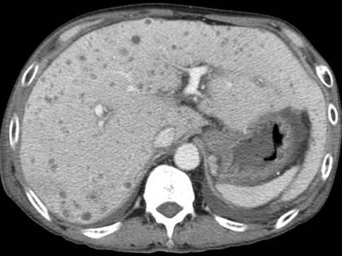 - Wan Suk Lee, et al: Four cases of multiple biliary hamartoma in the liver - Figure 5. A contrast-enhanced CT image of case 3 showing multiple hypodense lesions in the liver.