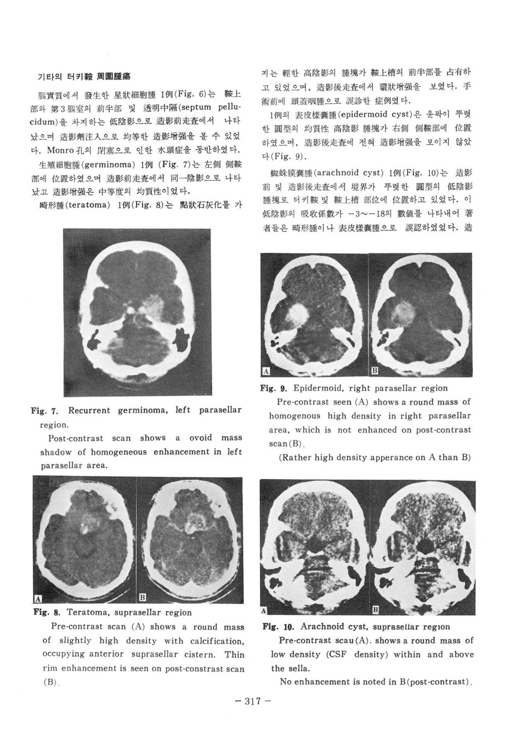 기타의터키敎周뼈 g훌훌 f짜 ft 質에서發生한星狀細뼈睡 1 Ø1J( Fig. 6) 는較上部와第 3 1. 폐室의前半部및透明中隔 (septum pellu cidum) 을차지하는低陰影 로造影前走훌에서나타났으며造影齊 l 注入으로均等한造影增彈을볼수있었다. Monro fl의다 l 쩔으로인한 7κ 頭 jje을통반하였다.