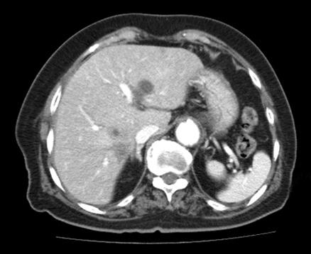 392 대한소화기내시경학회지 2008;36:390-394 Figure 2. Abdominal CT findings. (A) 5.5 5 cm sized liver abscess is noted in initial abdominal CT finding. (B) It CT shows free-air in periduodenum.
